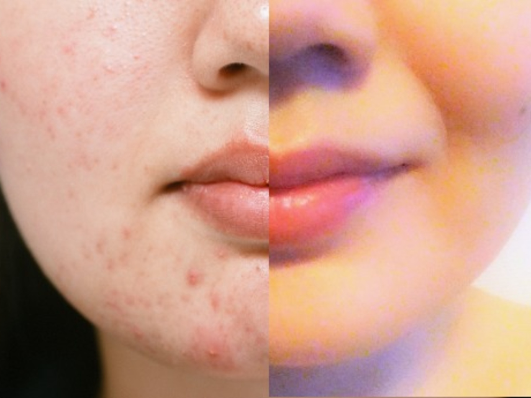 マスクネの治療方法