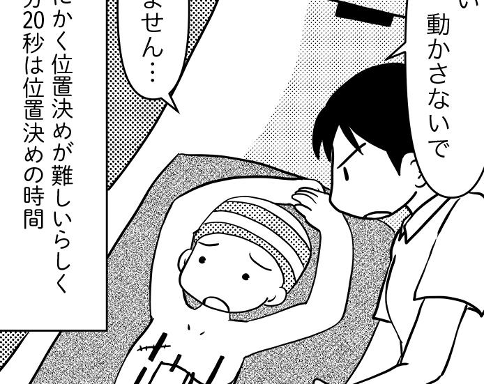 直腸への放射線療法